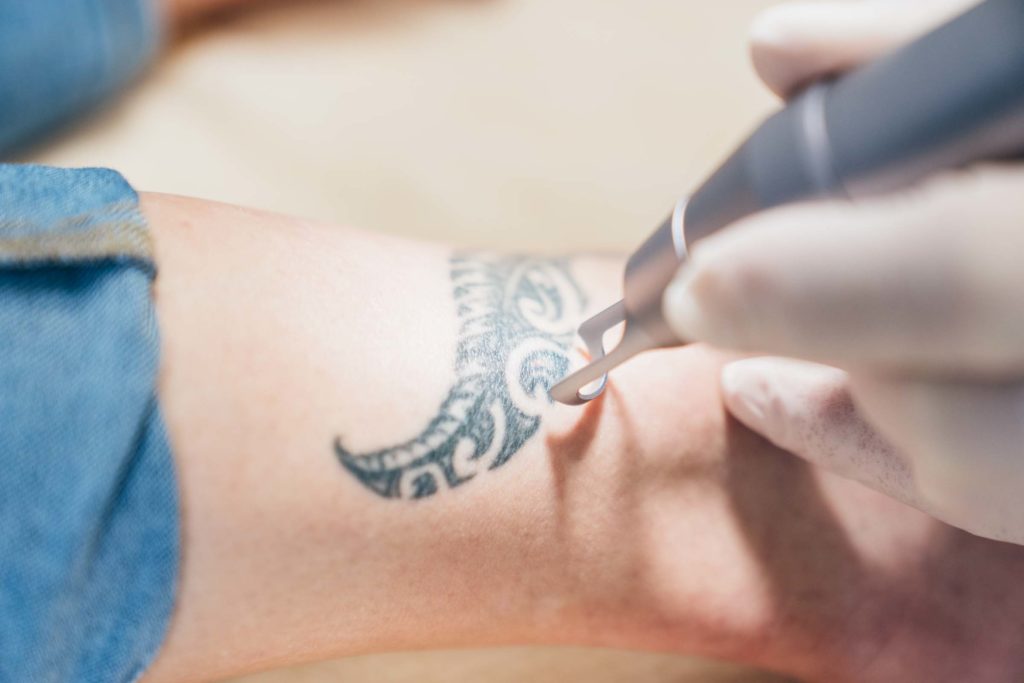 Laserzentrum Graz - Lasertherapie und Laserbehandlungen in Graz - Tattooentfernung in Graz 2