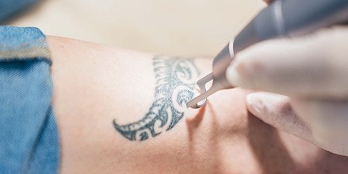 Tattooentfernung